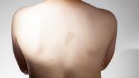 kid with neurofibromatosis